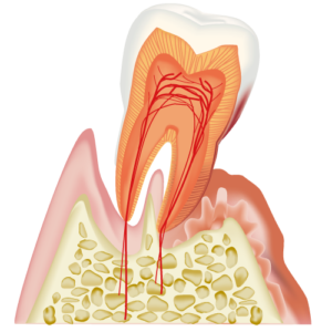 歯槽膿漏とは？歯周病との違いについても解説！