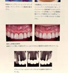 前歯インプラント、札幌、冊子掲載