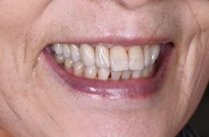 札幌、白い歯、笑顔、高齢、歯医者