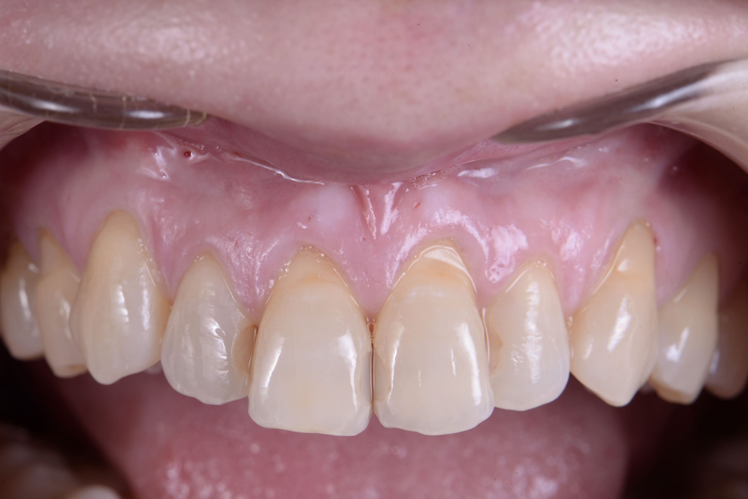 Q：歯ぐきの手術の時に注意することはありますか？