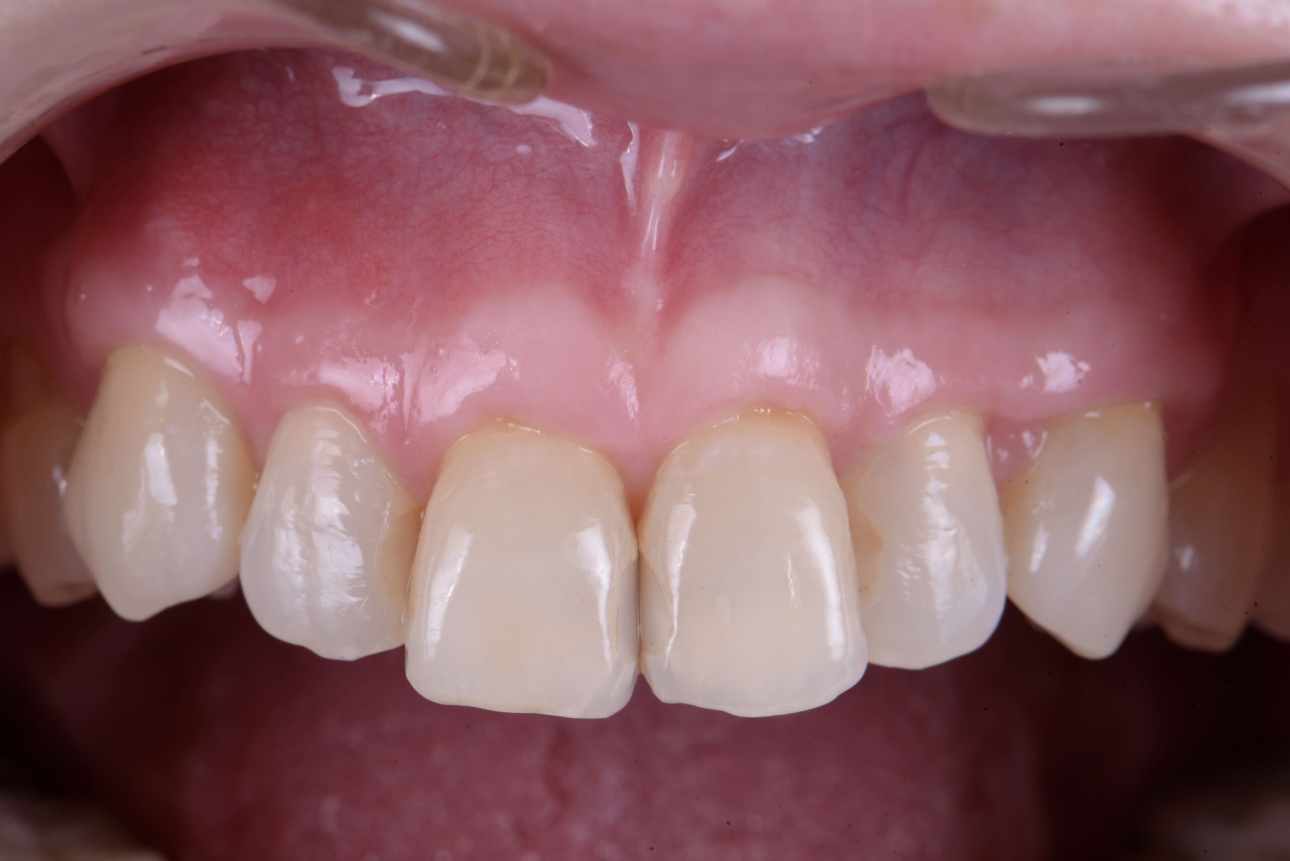 Q：歯ぐき下がりの原因は何ですか？