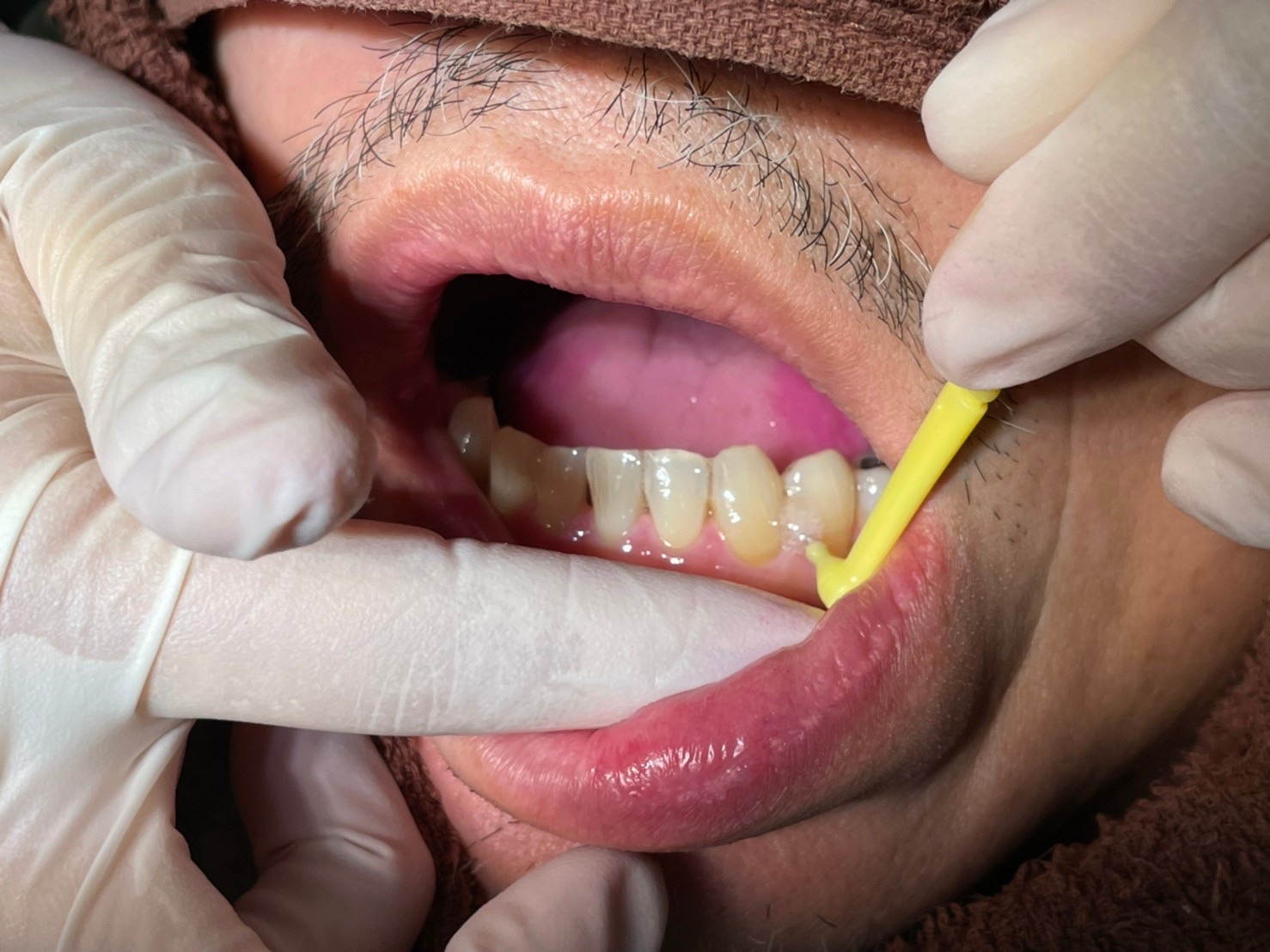 Q：歯ぐきの隙間（ブラックトライアングル）は歯ぐきの手術で治りますか？