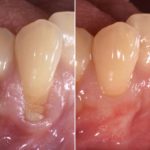 歯ぐき下がり（歯肉退縮）に対する根面被覆治療
