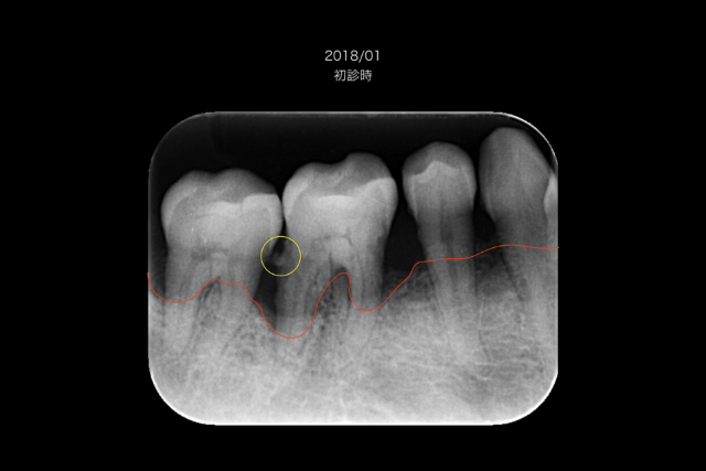 　歯周病の診断について