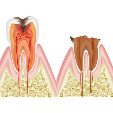 根管治療が必要な虫歯の段階