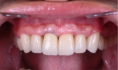 審美インプラントを可能にする歯茎のマネージメント