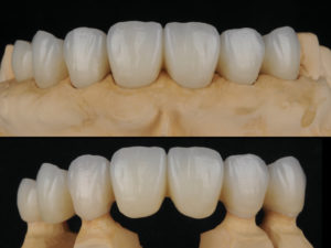 前歯インプラント上部構造