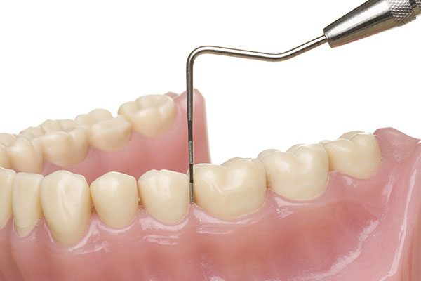 Q：歯周病治療の保険治療と自費治療の違いは何ですか？