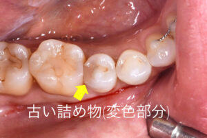 札幌、むし歯、歯医者、審美歯科