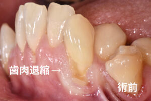 歯肉退縮、札幌、歯医者、世界基準、術前