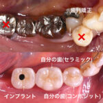 歯列矯正、インプラント、札幌、歯医者、審美歯科