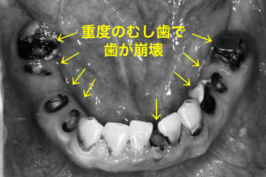 札幌、歯医者、歯科恐怖症、トラウマ、歯並び、むし歯、