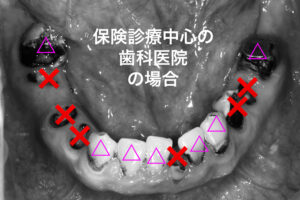 札幌、歯医者、むし歯治療、保険、抜歯