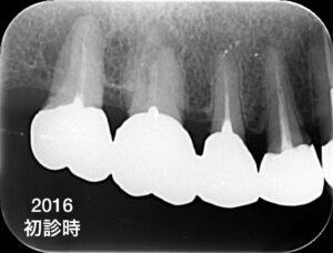 札幌、根管治療、歯の保存、抜かない、歯医者