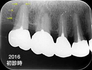 札幌、歯の根の治療、根管治療、歯医者