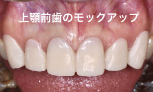 札幌、歯医者、前歯、ガミースマイル