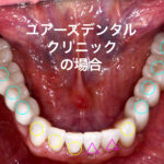 札幌、歯医者、むし歯治療、歯の保存、インプラント、口コミ
