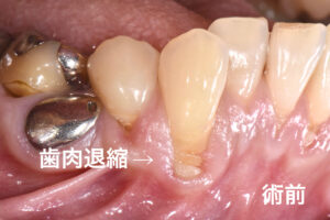札幌、歯医者、歯肉退縮、症例写真、口コミ、術前