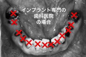 札幌、インプラント専門、歯医者、歯の保存、歯科医院