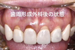 札幌、ガミースマイル、歯医者、審美歯科