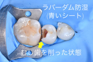 札幌、白い歯、むし歯、歯医者