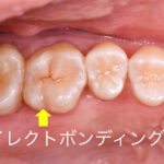 札幌、むし歯治療、歯医者、審美歯科、白い歯