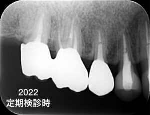 札幌、歯の根の治療、再生療法、歯医者