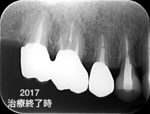 札幌、歯の根の治療、歯医者