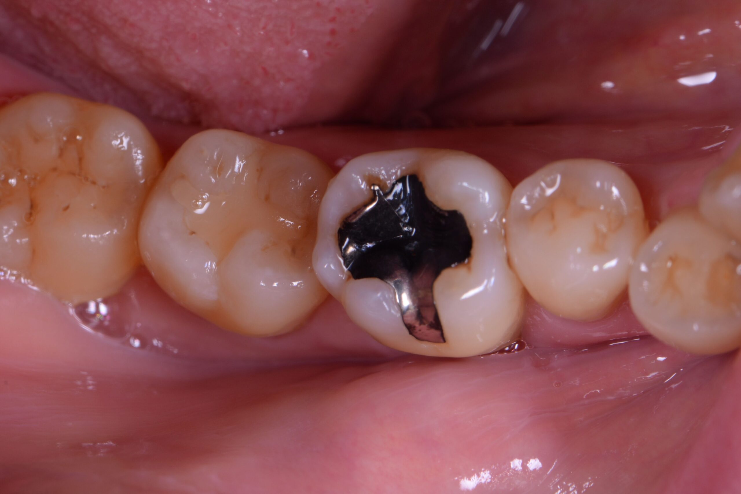 術前の状態・銀歯の下が虫歯になっている