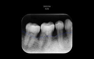 札幌、歯医者、再生療法、歯の保存